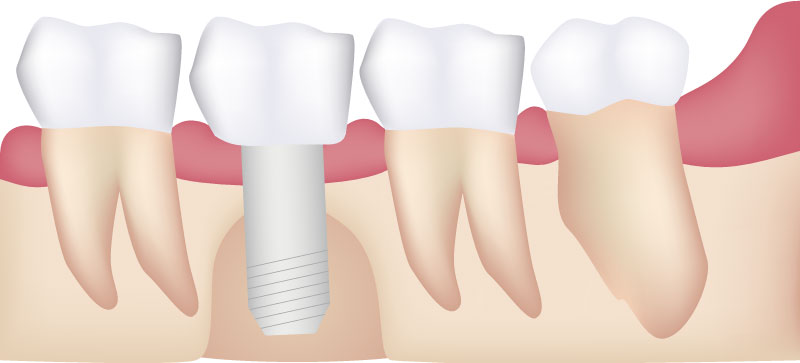 bone grafts