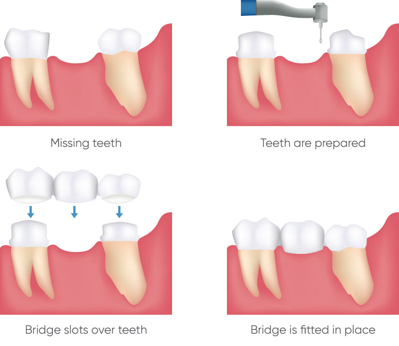 dental bridges chart